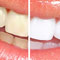 blanqueamiento-dental-th