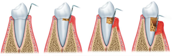 periodoncia